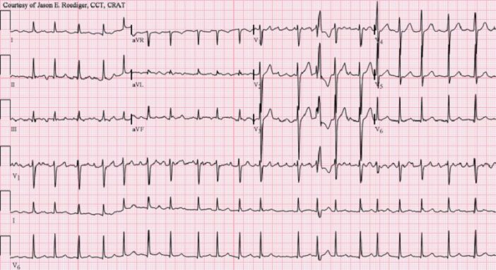 Fibrillazione atriale: aspettare troppo prima dell’ablazione può aumentare le recidive